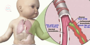 em bé sơ sinh thở khò khè
