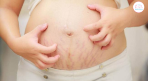 Cách Trị Rạn Da Đỏ