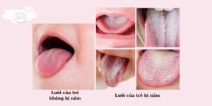 Cách Làm Sạch Lưỡi Bị Trắng Cho Trẻ Sơ Sinh